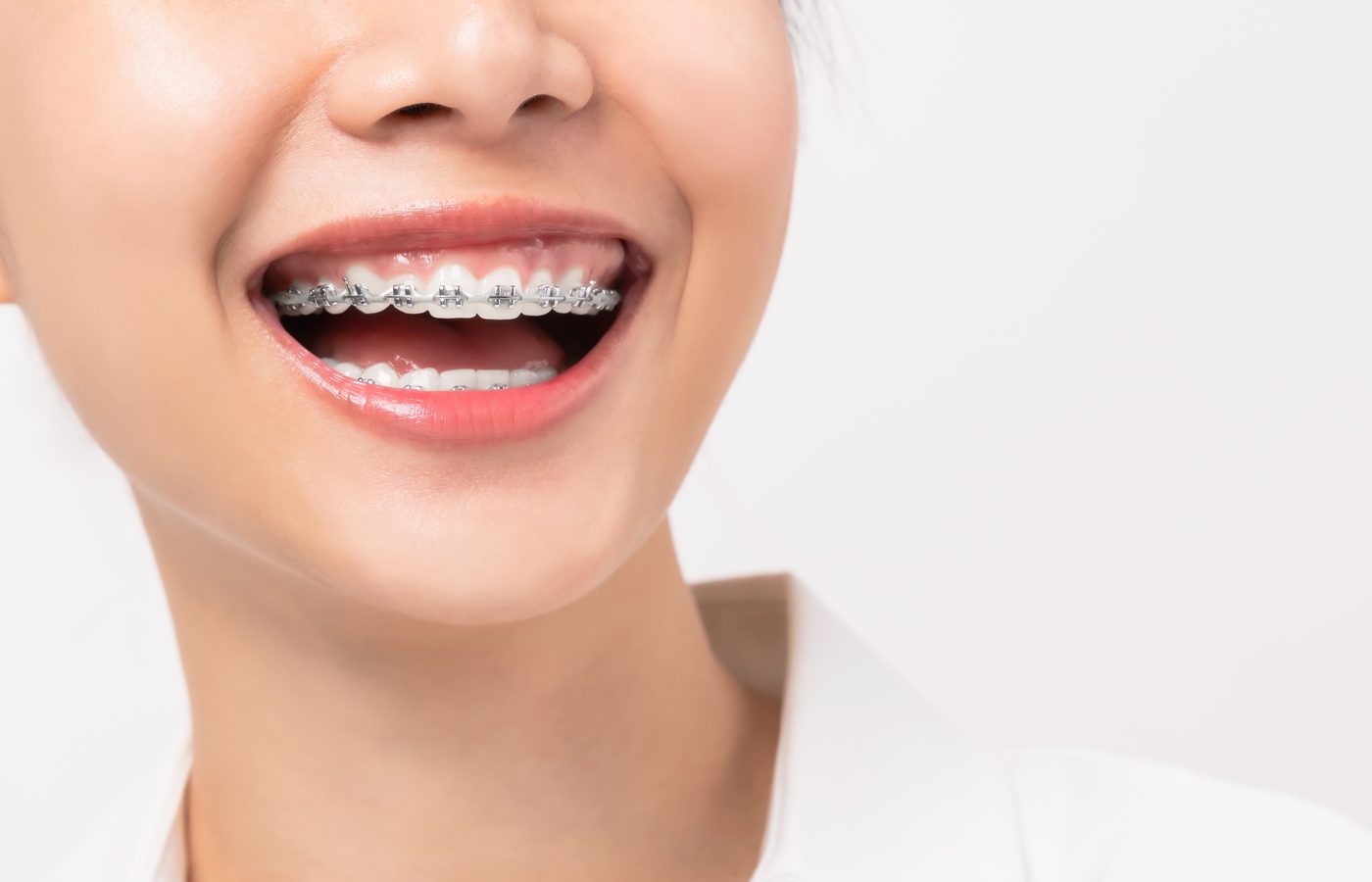 Smile with orthodontic treatment